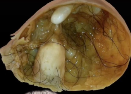 Woman finds out she's had ball of teeth and hair growing inside her for two years