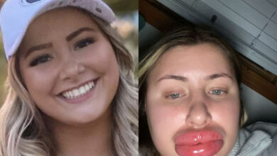 Woman’s lips swells to ‘eight times the normal size’ after allergic reaction to fillers