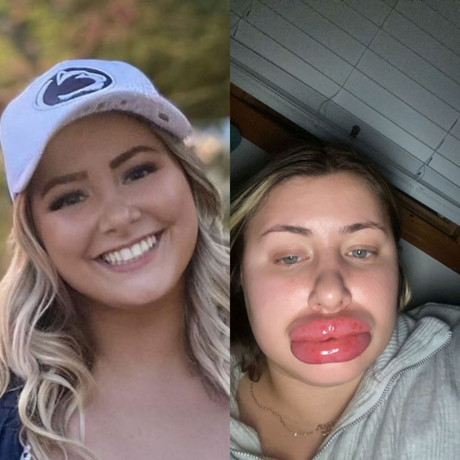 Woman's lips swells to 'eight times the normal size' after allergic reaction to fillers