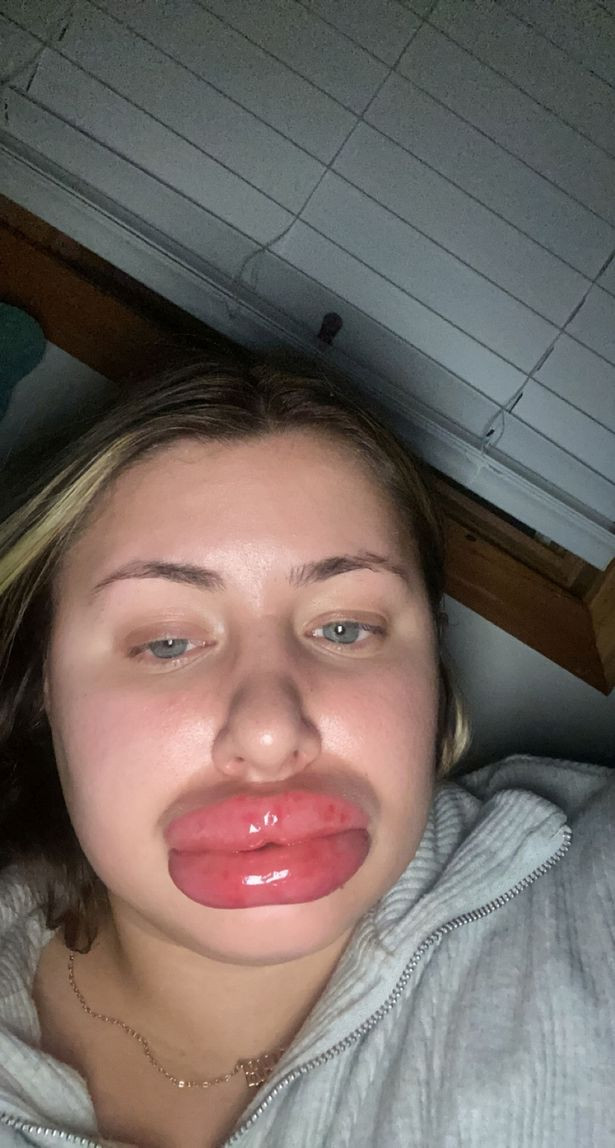 Woman's lips swells to 'eight times the normal size' after allergic reaction to fillers