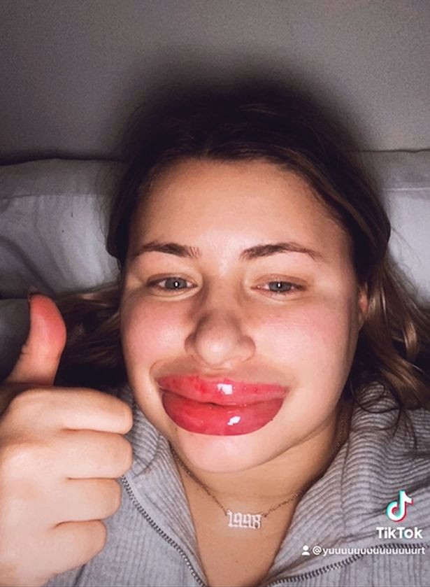 Woman's lips swells to 'eight times the normal size' after allergic reaction to fillers