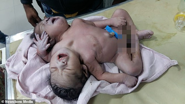 Baby is born with two heads, three arms and two hearts (Photos)