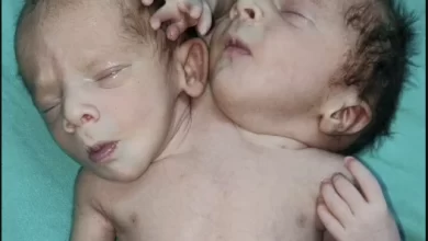 Baby is born with two heads, three arms and two hearts (Photos)
