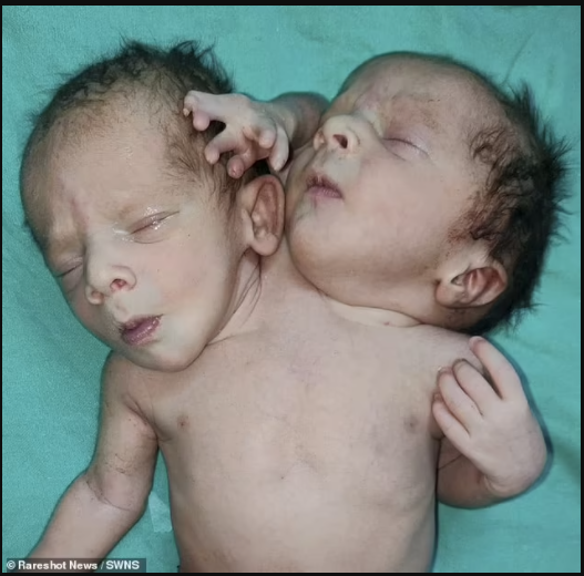 Baby is born with two heads, three arms and two hearts (Photos)