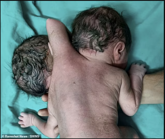 Baby is born with two heads, three arms and two hearts (Photos)