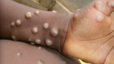 Monkey pox patient in London travelled from Nigeria, UK says
