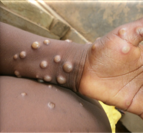 Monkey pox patient in London travelled from Nigeria, UK says